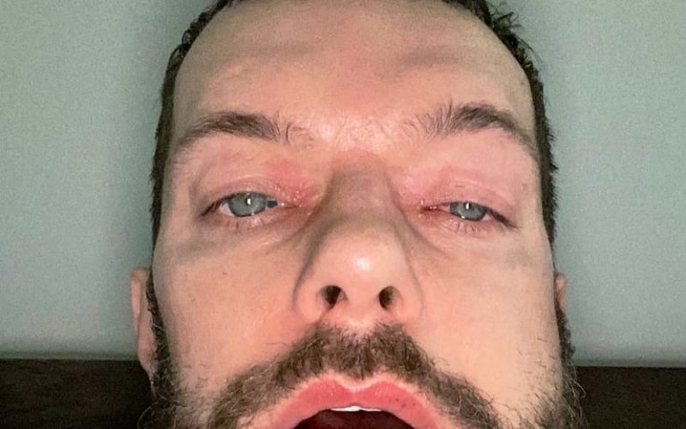 Finn Balor Shows Off Swollen Face After Jaw Surgery